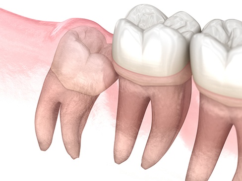 Digital illustration of impacted wisdom tooth